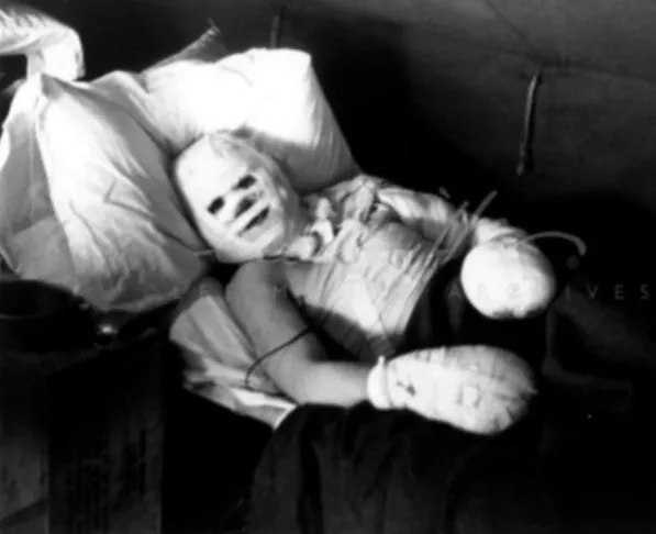 Black-and-white photograph of a patient lying in a hospital bed with his head, chest and hands completely wrapped in white bandages, leaving openings only for his eyes, nose and mouth.